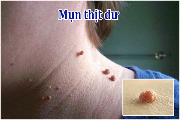 Mụn thịt dư