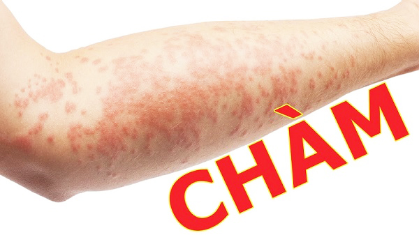 Bệnh chàm
