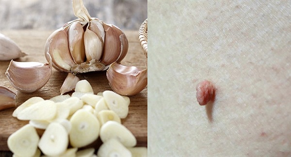 trị mụn thịt bằng tỏi