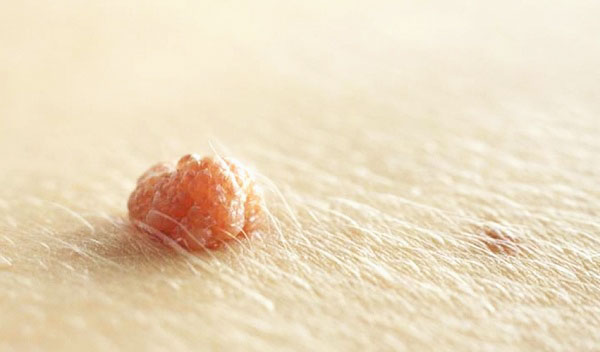 cách trị mụn thịt