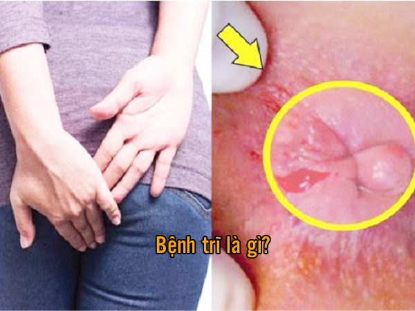 Bệnh trĩ là gì