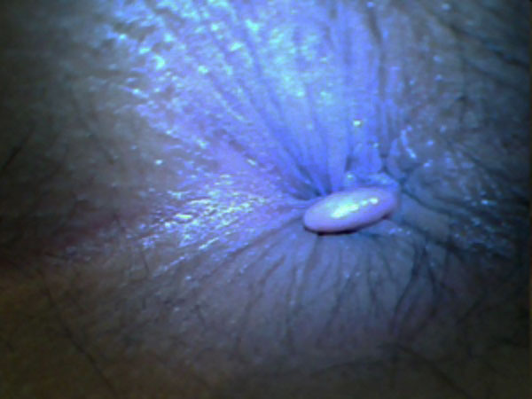 Trĩ ngoại độ 1