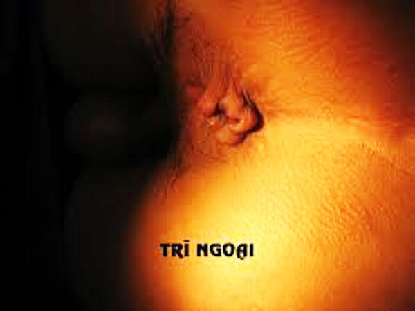 Trĩ ngoại độ 2