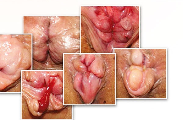 Trĩ ngoại độ 4