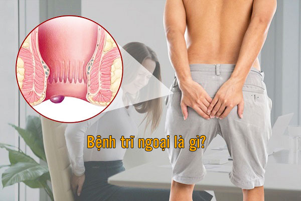 Bệnh trĩ ngoại