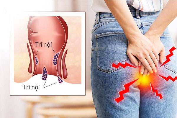 Bệnh trĩ nội