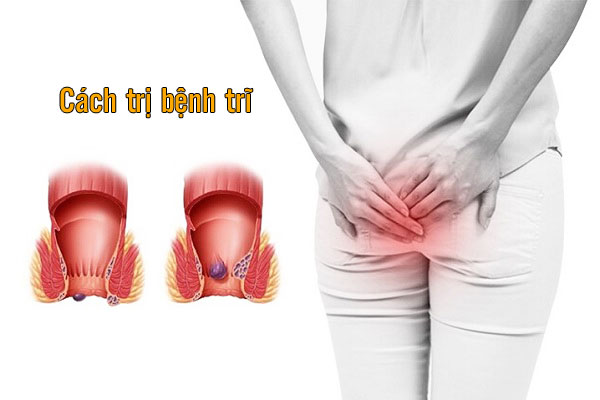 Bệnh trĩ