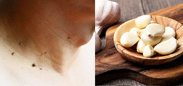 tỏi trị mụn thịt ở cổ