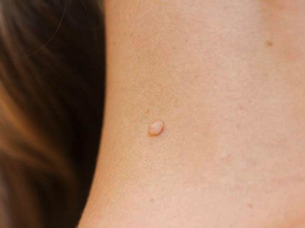 cách trị mụn thịt ở cổ