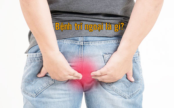 bệnh trĩ ngoại là gì