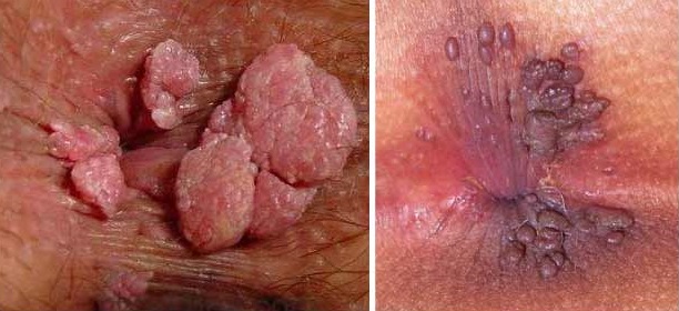 Mụn thịt ở hậu môn