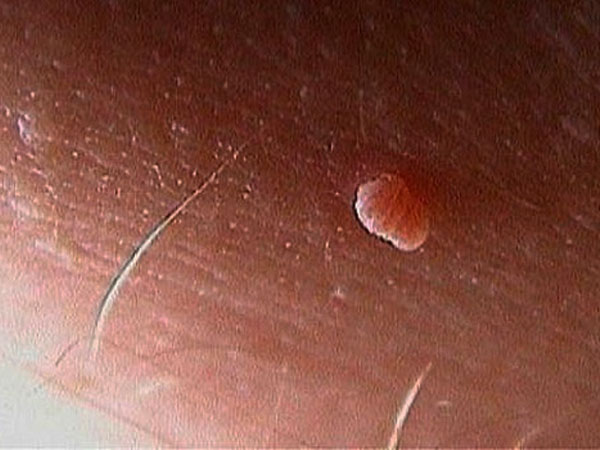 Mụn thịt ở vùng kín