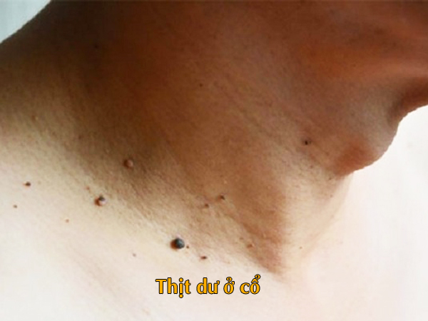 thịt dư ở cổ