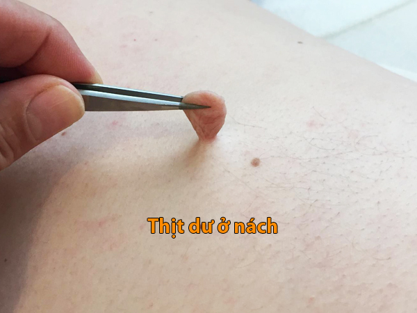 thịt dư ở nách