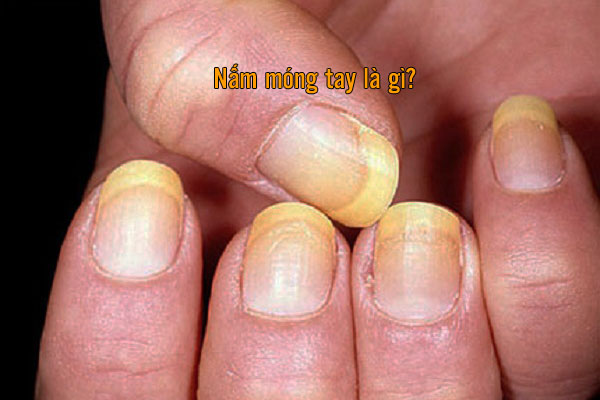 biểu hiện nấm móng tay