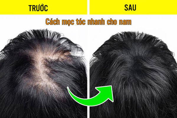 cách mọc tóc nhanh cho nam
