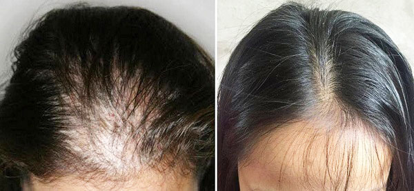 cách mọc tóc nhanh