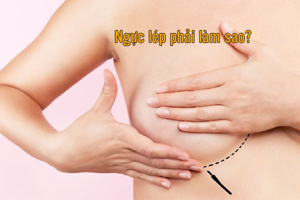 cải thiện ngực lép