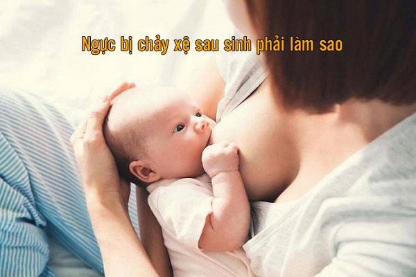 ngực bị chảy xệ sau sinh phải làm sao