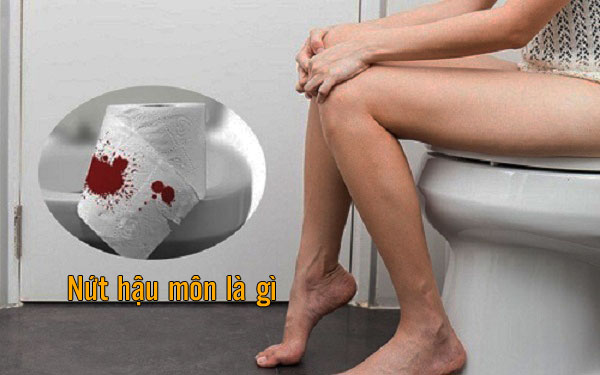 nứt hậu môn triệu chứng