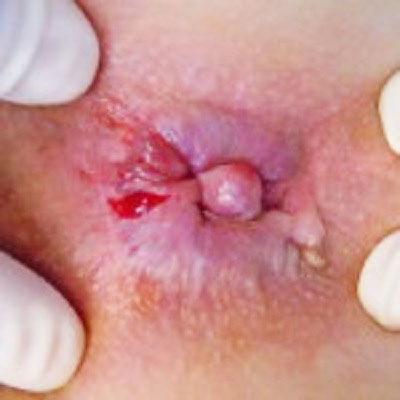 bệnh trĩ cấp độ 3