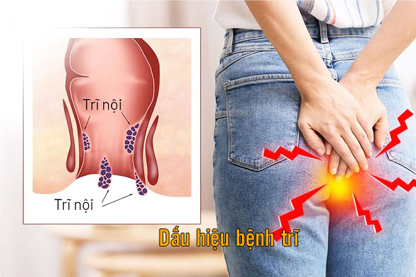 dấu hiệu bệnh trĩ ở phụ nữ