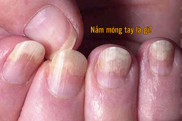 hình ảnh nấm móng tay