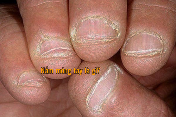 hình ảnh nấm móng tay