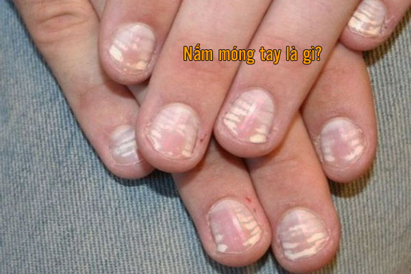hình ảnh nấm móng tay