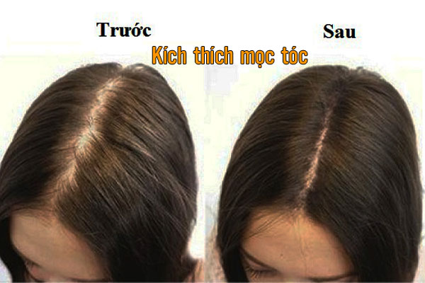 kích thích mọc tóc