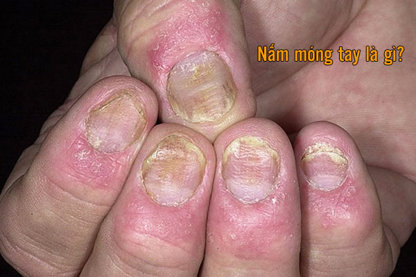 Nấm móng tay