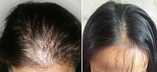 những cách trị rụng tóc và kích thích mọc tóc