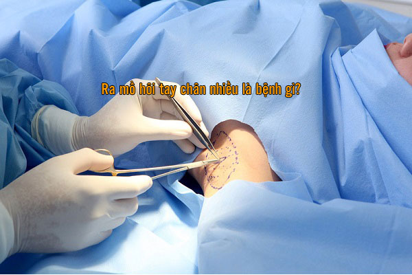 điều trị mồ hôi tay chân