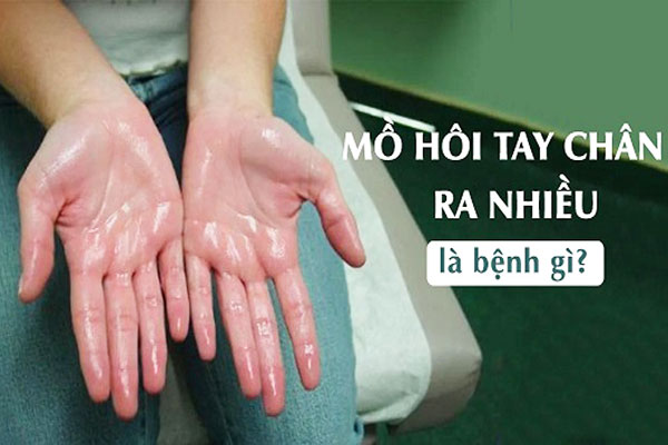 ra mồ hôi tay chân