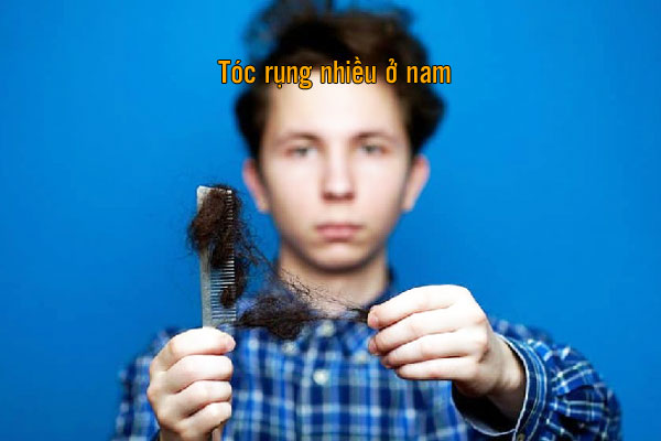 rụng tóc nhiều ở nam tuổi 17 có sao không
