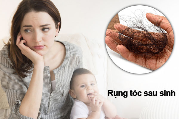 rụng tóc sau sinh
