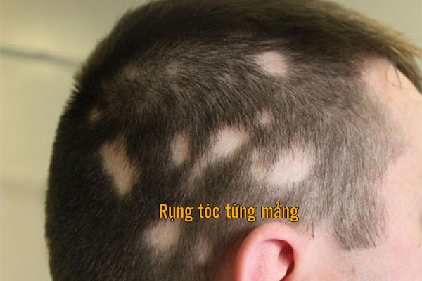 Rụng tóc từng mảng
