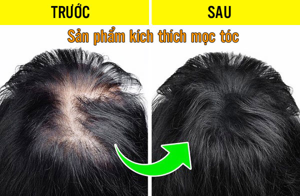 sản phẩm kích thích mọc tóc