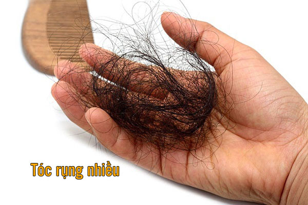 tóc rụng nhiều