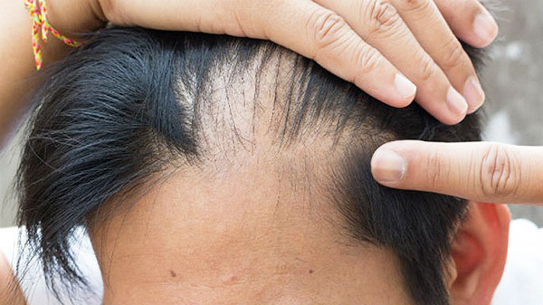 tóc rụng nhiều ở nam
