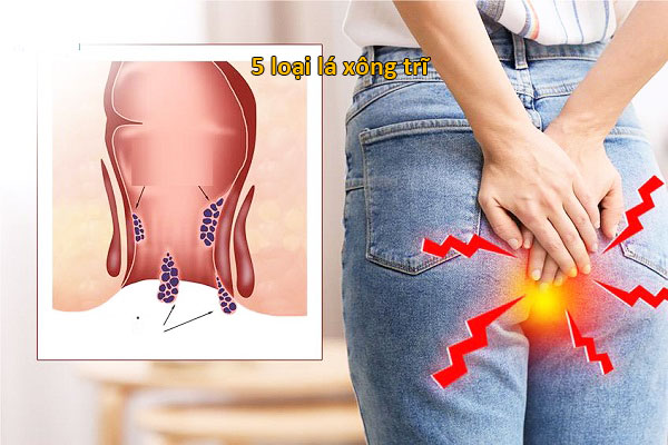 5 loại lá xông trĩ