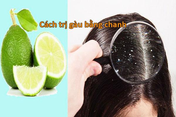 cách trị gàu bằng chanh