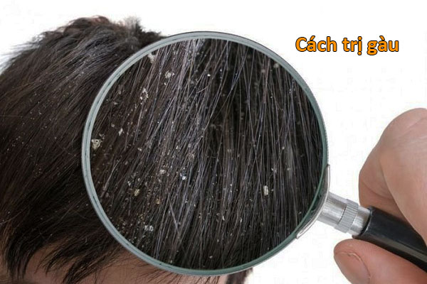 cách trị gàu