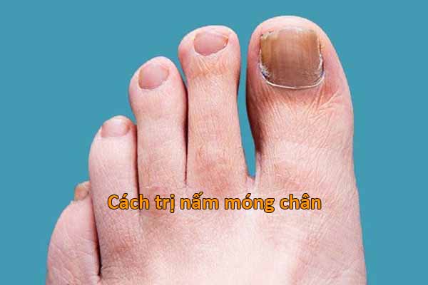 cách trị nấm móng chân