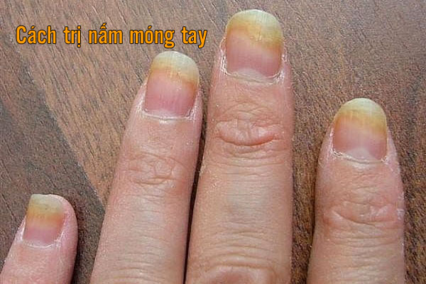 cách trị nấm móng tay