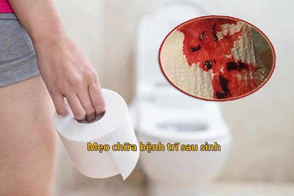 dấu hiệu bệnh trĩ ở phụ nữ sau sinh