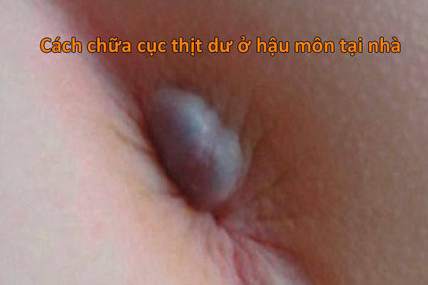 hậu môn có cục thịt dư