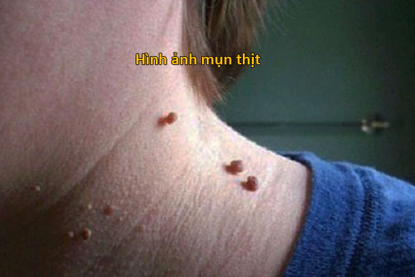 Hình ảnh mụn thịt ở cổ