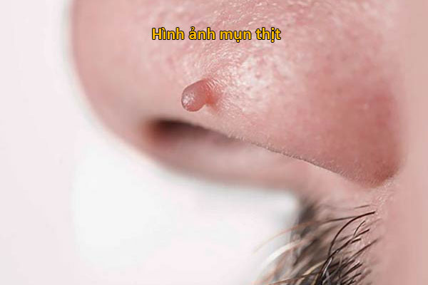 hình ảnh mụn thịt ở mũi