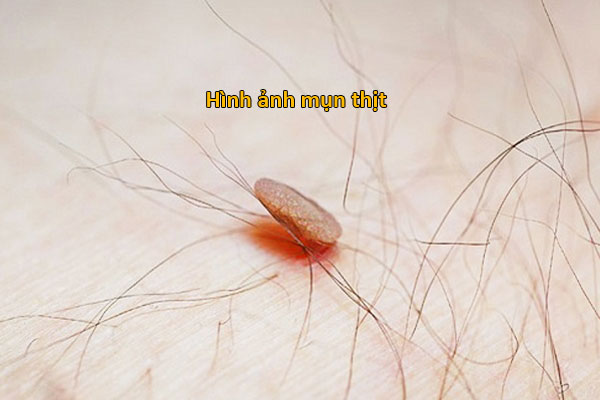 hình ảnh mụn thịt ở nách